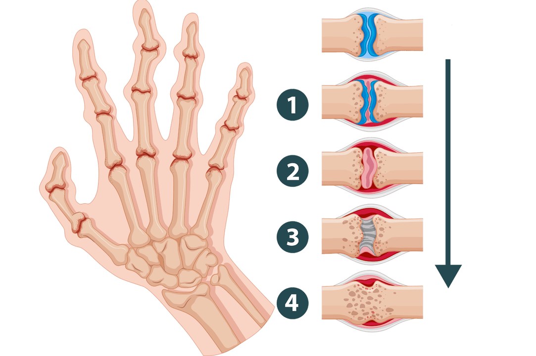Fases de desenvolvemento da artrite - dano inflamatorio articular