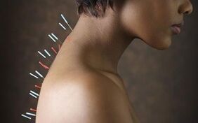 Acupuntura