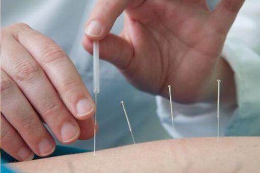 A acupuntura é un método para tratar a dor lumbar causada pola osteocondrose