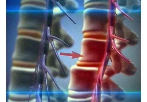 Compresión das terminacións nerviosas na osteocondrose lumbar