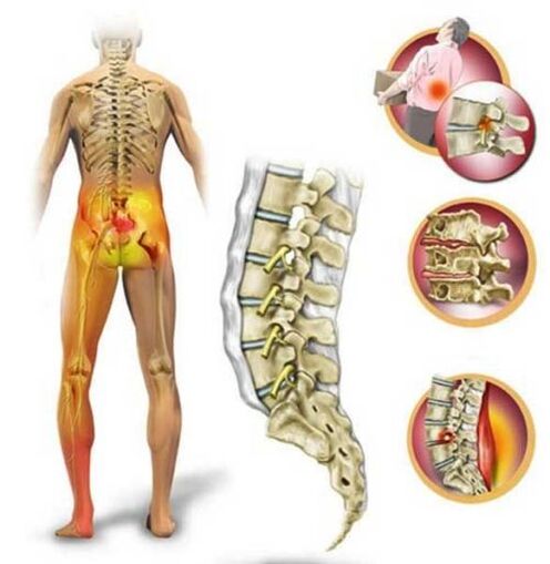 Osteocondrose da columna lumbar, causando dor na parte baixa das costas