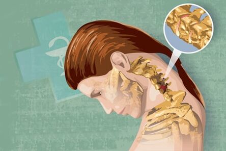 Síntomas reflexos da osteocondrose