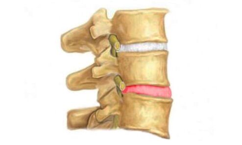 Abombamento do disco intervertebral da columna vertebral - un sinal de osteocondrose